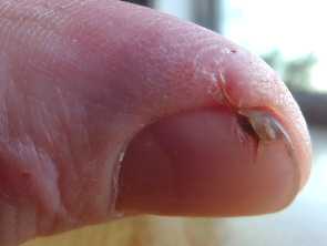 Finger saw cut healed with aloe gel day 24