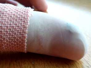 Finger saw cut healed with aloe gel day 7